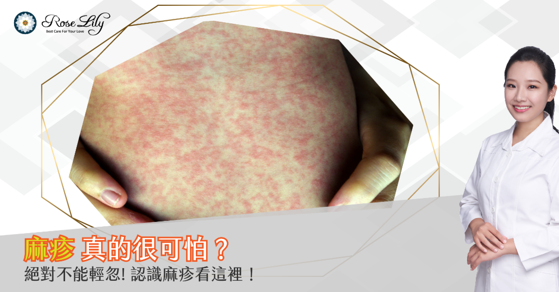 麻疹真的很可怕? 認識麻疹看這裡! - 育兒專欄 | 【蘿絲莉莉 RoseLily】專業級嬰兒副食品/寶寶副食品/寶寶粥